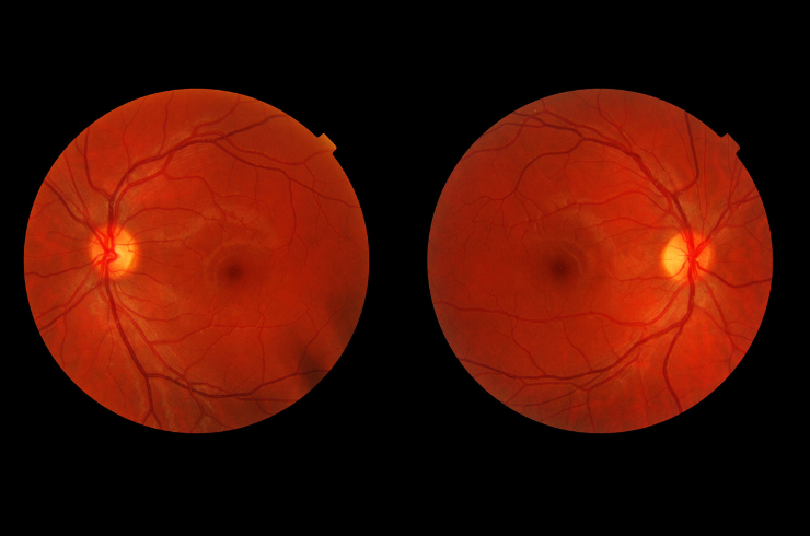 Diabetic retinopathy