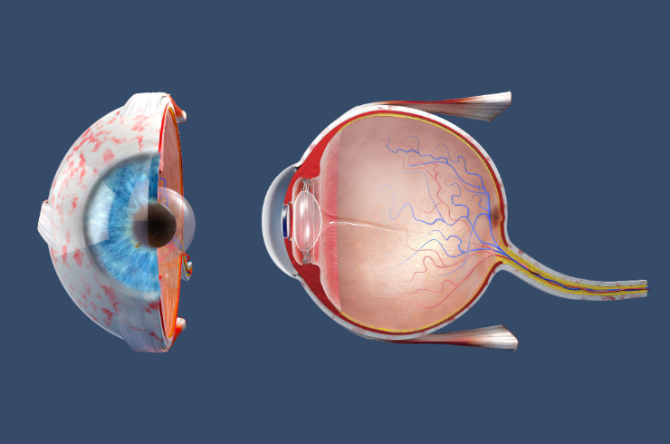 Keratoconus