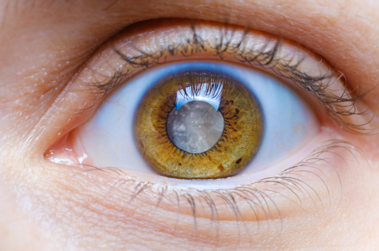 cataract